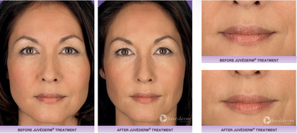 juvederm fillers, fillers, antiaging, wrinkles, confidence, before and after